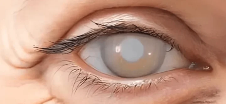 catarract