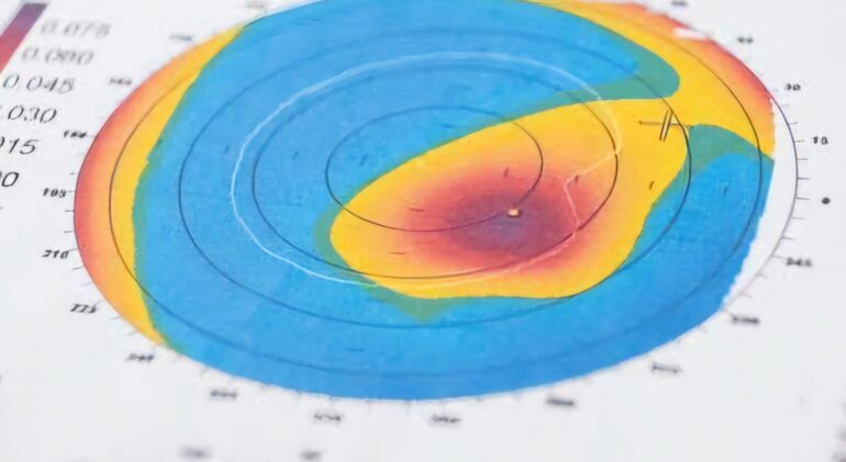 Cornea Thickness Cornea Thickness