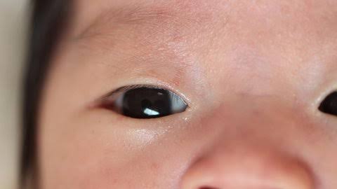 Retinopathy of Prematurity Stages
