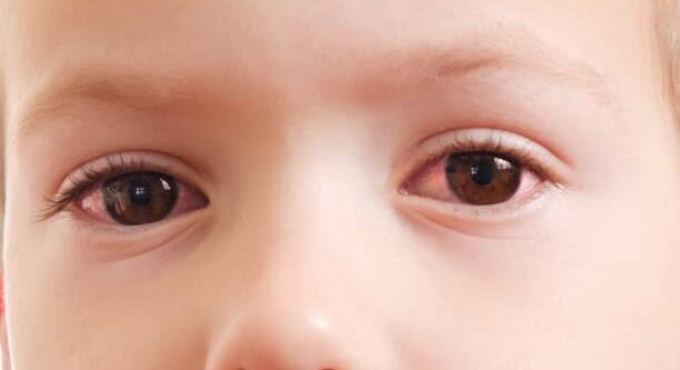 Eye Infection in Kids