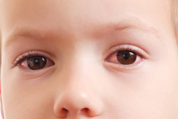 Eye Infection in Kids Eye Infection in Kids