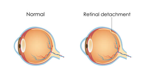 Detached Retina