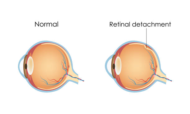 Detached Retina