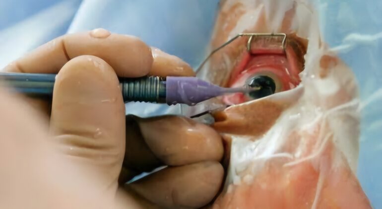 Types of Cataract