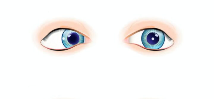 Squint Eye