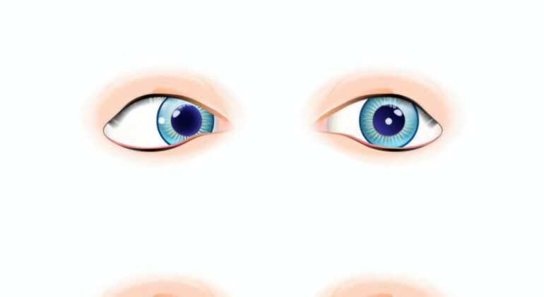Squint Eye