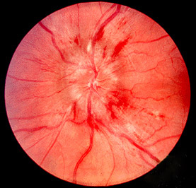 Papilledema Meaning