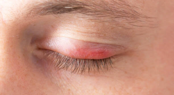 Swollen eyelid cure