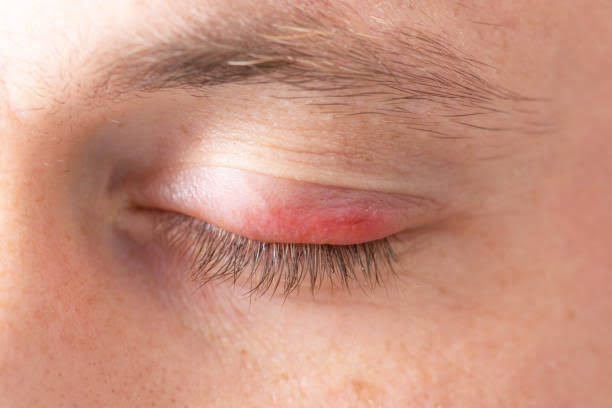 Swollen eyelid cure