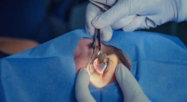 glaucoma surgery