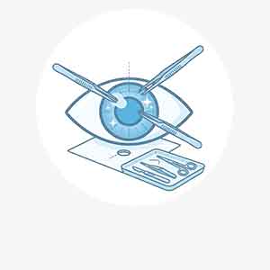 Refractive Surgery