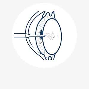 Cataract